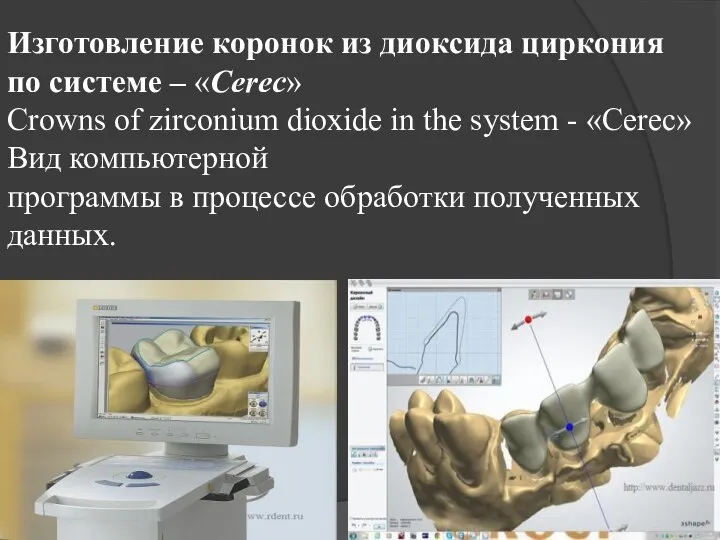 Изготовление коронок из диоксида циркония по системе – «Cerec» Crowns of