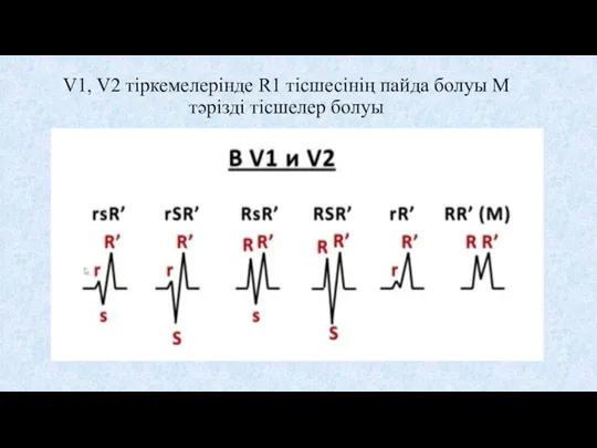 V1, V2 тіркемелерінде R1 тісшесінің пайда болуы М тәрізді тісшелер болуы