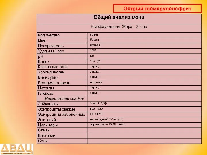 Острый гломерулонефрит