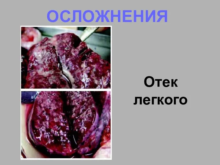 ОСЛОЖНЕНИЯ Отек легкого