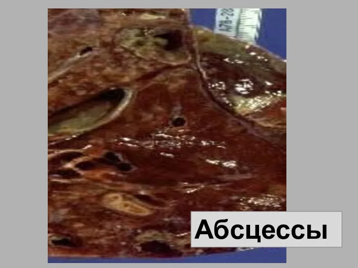 Абсцессы