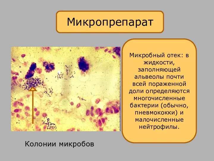 Микропрепарат Микробный отек: в жидкости, заполняющей альвеолы почти всей пораженной доли