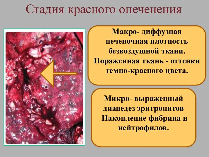 Стадия красного опеченения Макро- диффузная печеночная плотность безвоздушной ткани. Пораженная ткань