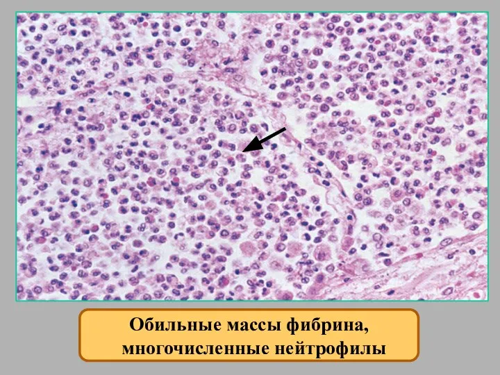 Обильные массы фибрина, многочисленные нейтрофилы