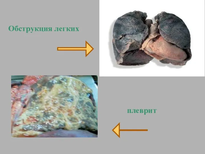 Обструкция легких плеврит