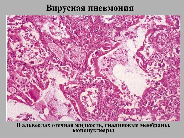 Вирусная пневмония В альвеолах отечная жидкость, гиалиновые мембраны, мононуклеары
