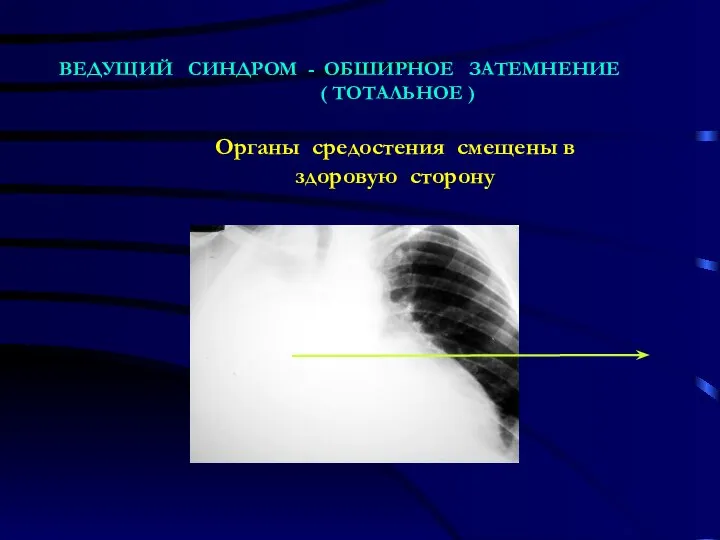 ВЕДУЩИЙ СИНДРОМ - ОБШИРНОЕ ЗАТЕМНЕНИЕ ( ТОТАЛЬНОЕ ) Органы средостения смещены в здоровую сторону