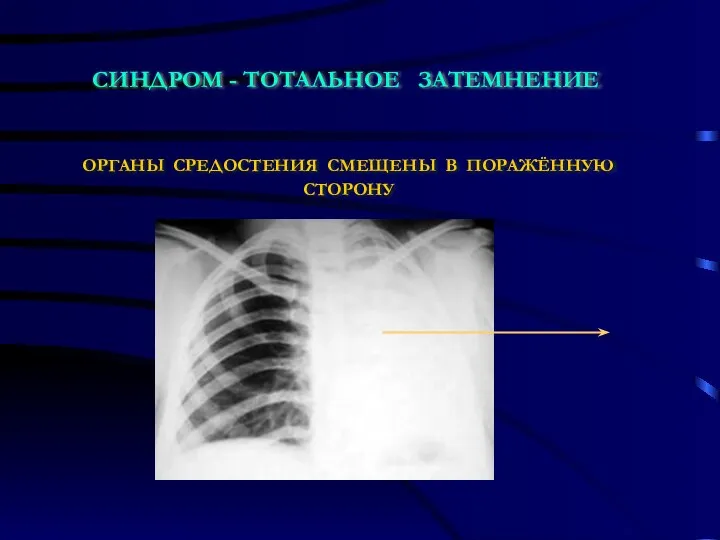 СИНДРОМ - ТОТАЛЬНОЕ ЗАТЕМНЕНИЕ ОРГАНЫ СРЕДОСТЕНИЯ СМЕЩЕНЫ В ПОРАЖЁННУЮ СТОРОНУ