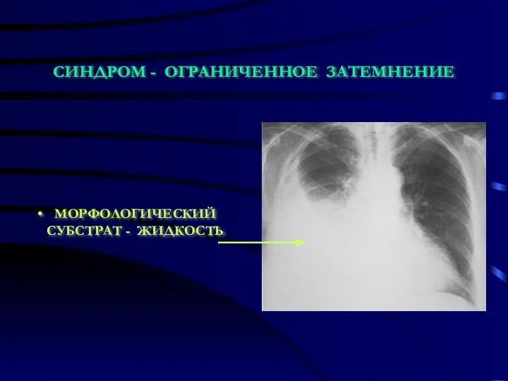 СИНДРОМ - ОГРАНИЧЕННОЕ ЗАТЕМНЕНИЕ МОРФОЛОГИЧЕСКИЙ СУБСТРАТ - ЖИДКОСТЬ