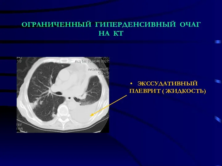 ОГРАНИЧЕННЫЙ ГИПЕРДЕНСИВНЫЙ ОЧАГ НА КТ ЭКССУДАТИВНЫЙ ПЛЕВРИТ ( ЖИДКОСТЬ)