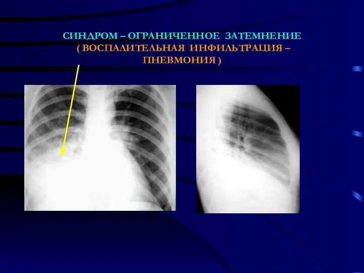 СИНДРОМ – ОГРАНИЧЕННОЕ ЗАТЕМНЕНИЕ ( ВОСПАЛИТЕЛЬНАЯ ИНФИЛЬТРАЦИЯ – ПНЕВМОНИЯ )