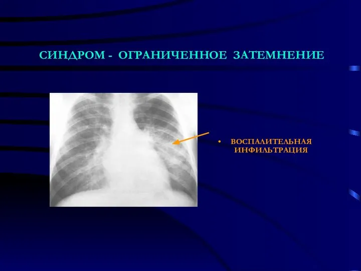 СИНДРОМ - ОГРАНИЧЕННОЕ ЗАТЕМНЕНИЕ ВОСПАЛИТЕЛЬНАЯ ИНФИЛЬТРАЦИЯ