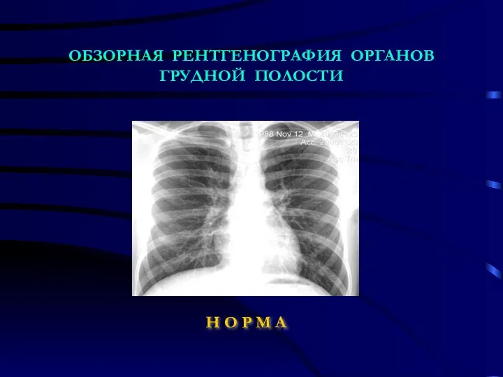 ОБЗОРНАЯ РЕНТГЕНОГРАФИЯ ОРГАНОВ ГРУДНОЙ ПОЛОСТИ Н О Р М А