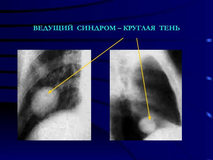 ВЕДУЩИЙ СИНДРОМ – КРУГЛАЯ ТЕНЬ