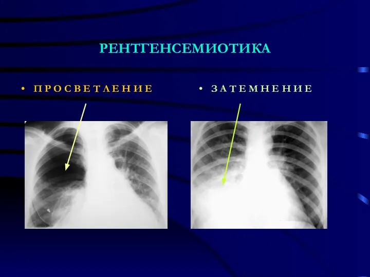 РЕНТГЕНСЕМИОТИКА П Р О С В Е Т Л Е Н