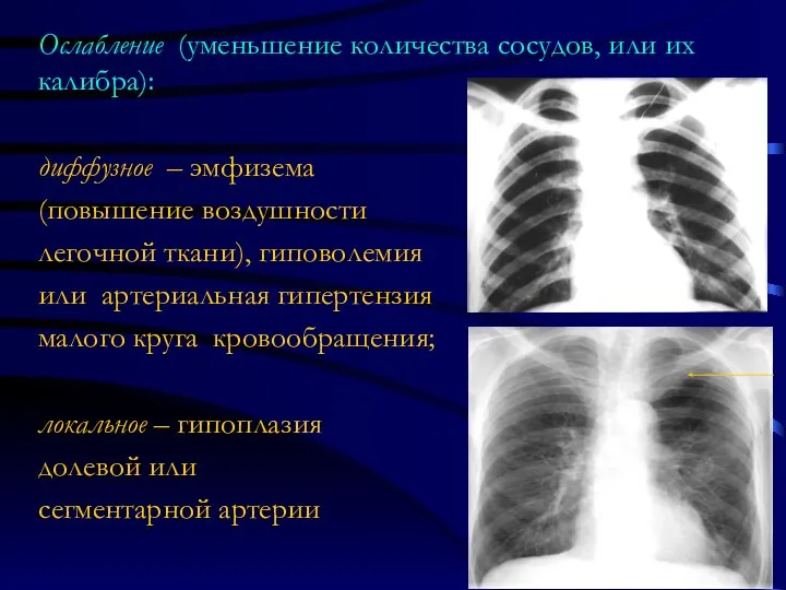 Ослабление (уменьшение количества сосудов, или их калибра): диффузное – эмфизема (повышение