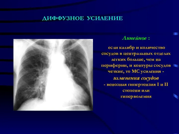 Линейное : если калибр и количество сосудов в центральных отделах легких