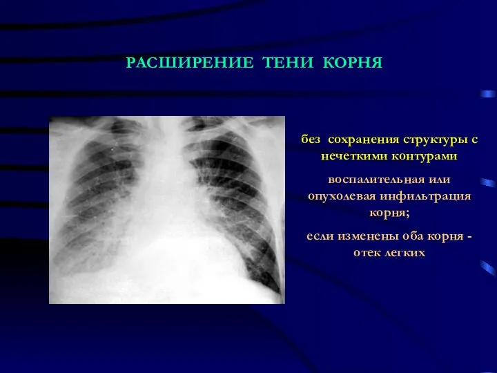 без сохранения структуры с нечеткими контурами воспалительная или опухолевая инфильтрация корня;