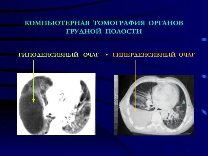 КОМПЬЮТЕРНАЯ ТОМОГРАФИЯ ОРГАНОВ ГРУДНОЙ ПОЛОСТИ ГИПОДЕНСИВНЫЙ ОЧАГ ГИПЕРДЕНСИВНЫЙ ОЧАГ