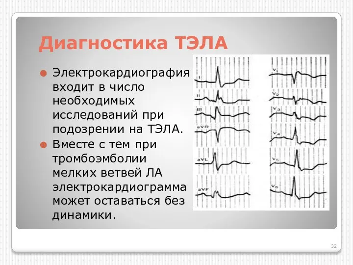 Диагностика ТЭЛА Электрокардиография входит в число необходимых исследований при подозрении на