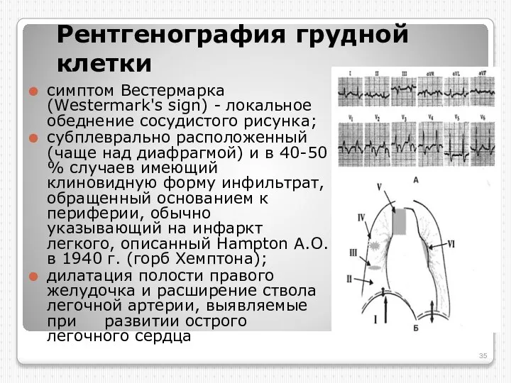 Рентгенография грудной клетки симптом Вестермарка (Westermark's sign) - локальное обеднение сосудистого