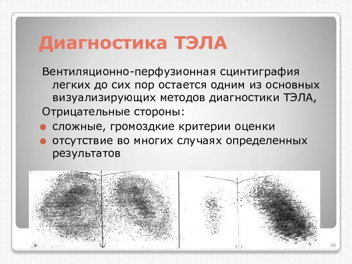 Диагностика ТЭЛА Вентиляционно-перфузионная сцинтиграфия легких до сих пор остается одним из