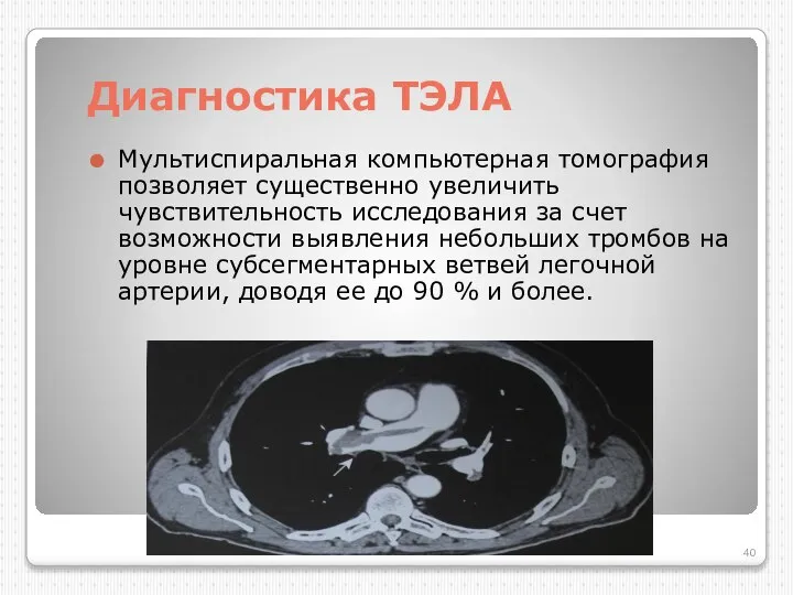 Диагностика ТЭЛА Мультиспиральная компьютерная томография позволяет существенно увеличить чувствительность исследования за