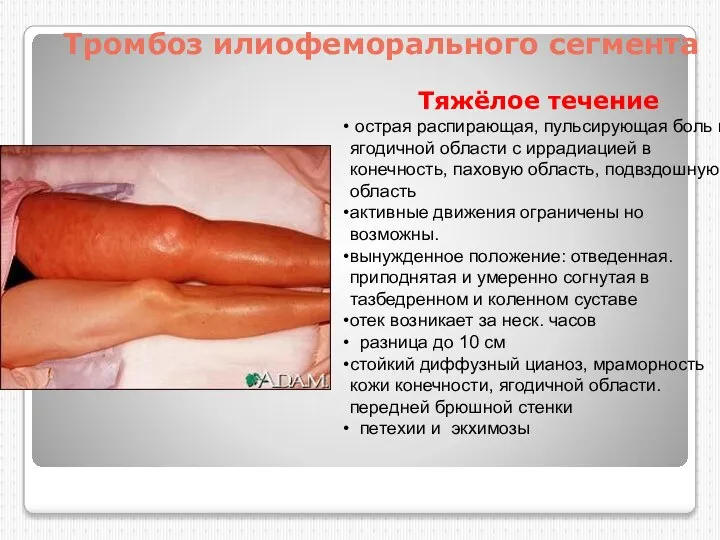 Тромбоз илиофеморального сегмента Тяжёлое течение острая распирающая, пульсирующая боль в ягодичной