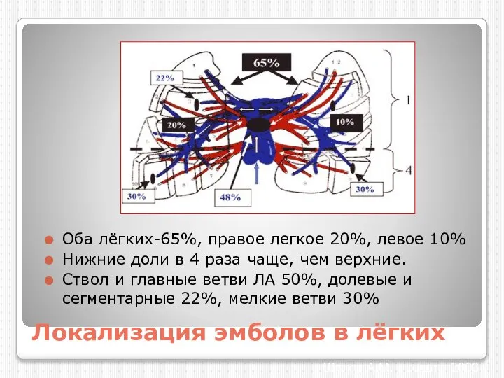 Локализация эмболов в лёгких Оба лёгких-65%, правое легкое 20%, левое 10%