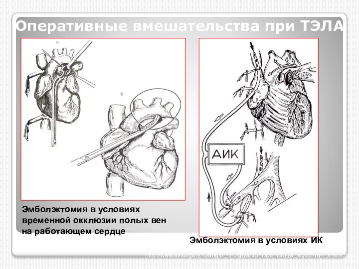 Оперативные вмешательства при ТЭЛА Эмболэктомия в условиях временной окклюзии полых вен