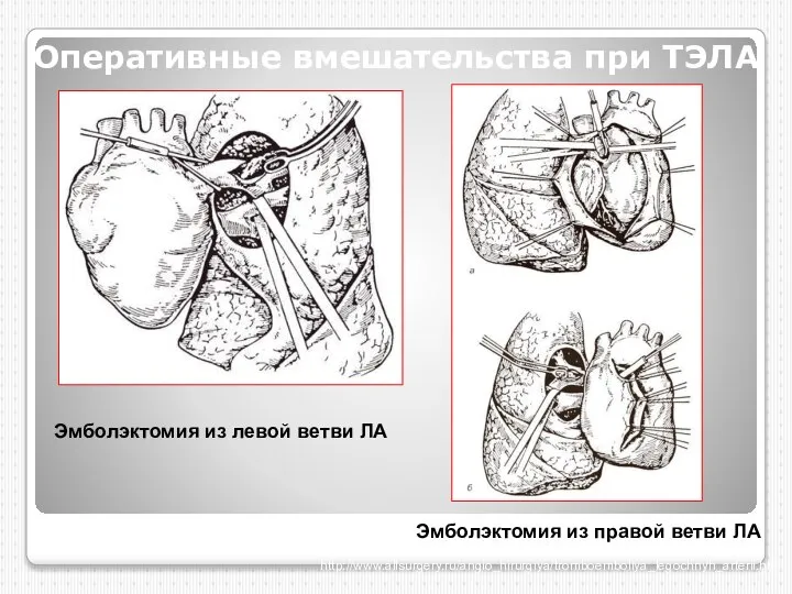 Оперативные вмешательства при ТЭЛА Эмболэктомия из левой ветви ЛА Эмболэктомия из правой ветви ЛА http://www.allsurgery.ru/angio_hirurgiya/tromboemboliya_legochnyh_arterii.html