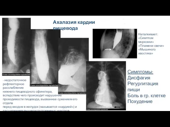 Ахалазия кардии пищевода - недостаточное рефлекторное расслабление нижнего пищеводного сфинктера, вследствие