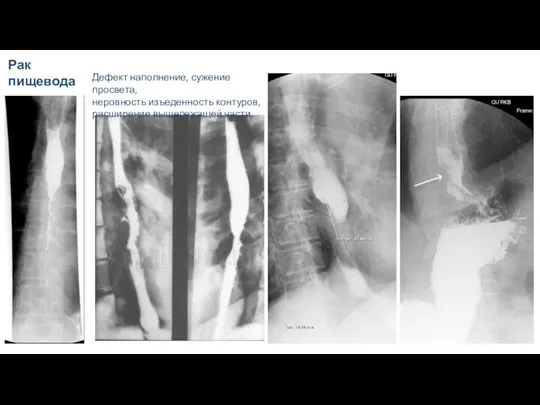 Рак пищевода Дефект наполнение, сужение просвета, неровность изъеденность контуров, расширение вышележащей части.