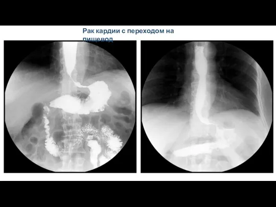 Рак кардии с переходом на пищевод