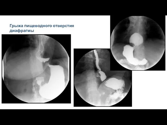 Грыжа пищеводного отверстия диафрагмы