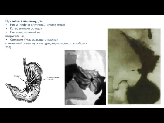 Признаки язвы желудка: Ниша (дефект слизистой; кратер язвы) Конвергенция складок Инфильтративный