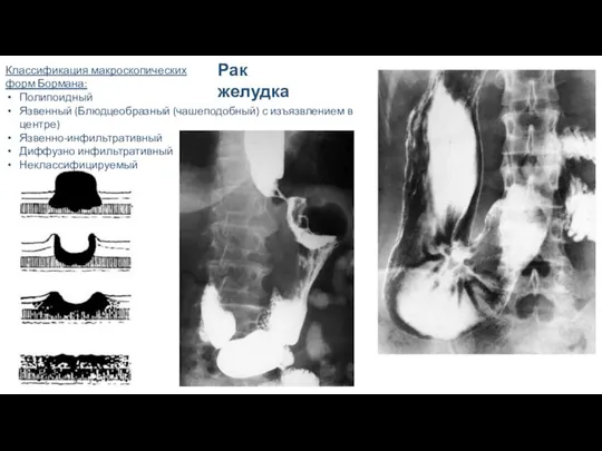 Рак желудка Классификация макроскопических форм Бормана: Полипоидный Язвенный (Блюдцеобразный (чашеподобный) с