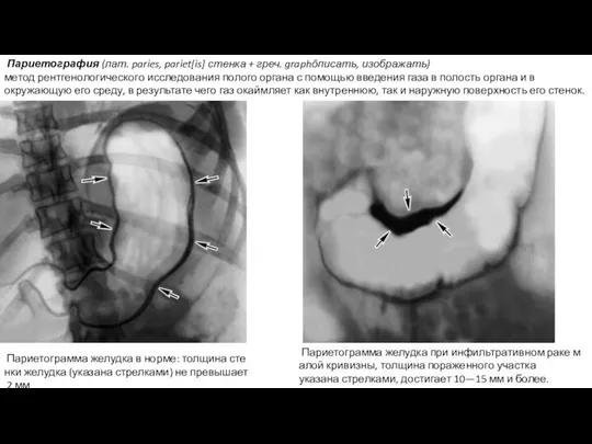 Париетограмма желудка при инфильтративном раке малой кривизны, толщина пораженного участка указана