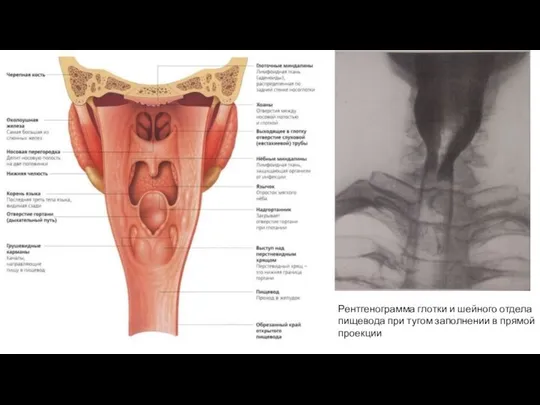 Рентгенограмма глотки и шейного отдела пищевода при тугом заполнении в прямой проекции