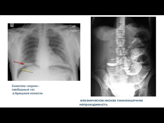 Симптом «серпа» - свободный газ в брюшной полости механическая низкая тонкокишечная непроходимость