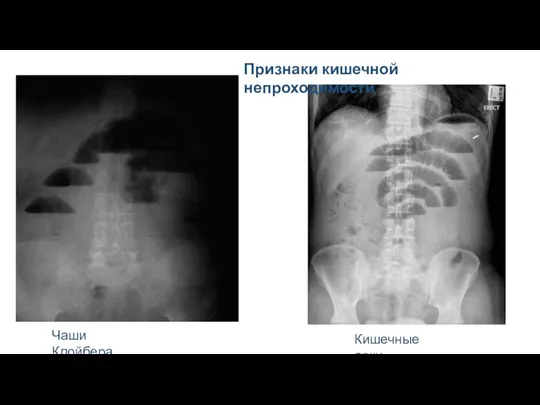 Чаши Клойбера Кишечные арки Признаки кишечной непроходимости