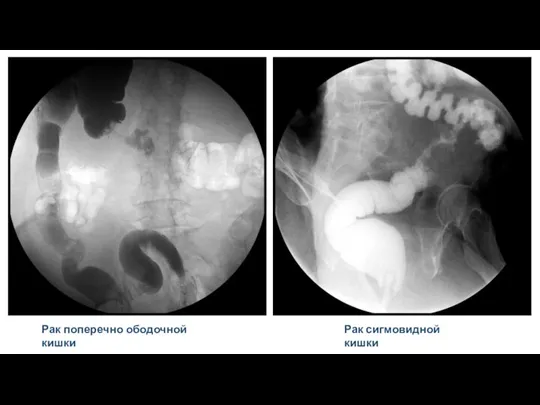 Рак поперечно ободочной кишки Рак сигмовидной кишки