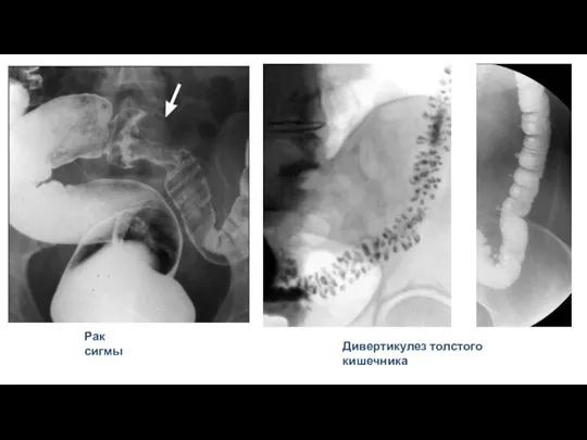 Рак сигмы Дивертикулез толстого кишечника