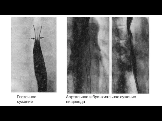 Глоточное сужение Аортальное и бронхиальное сужение пищевода