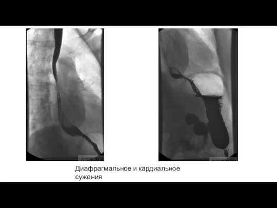 Диафрагмальное и кардиальное сужения