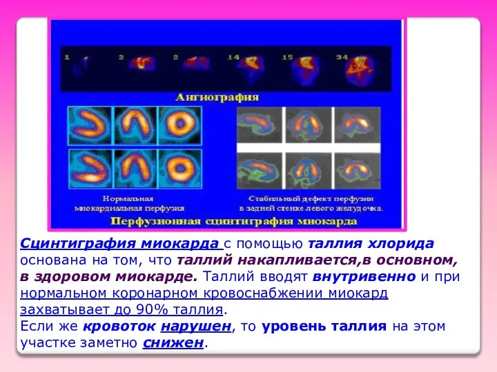 Сцинтиграфия миокарда с помощью таллия хлорида основана на том, что таллий