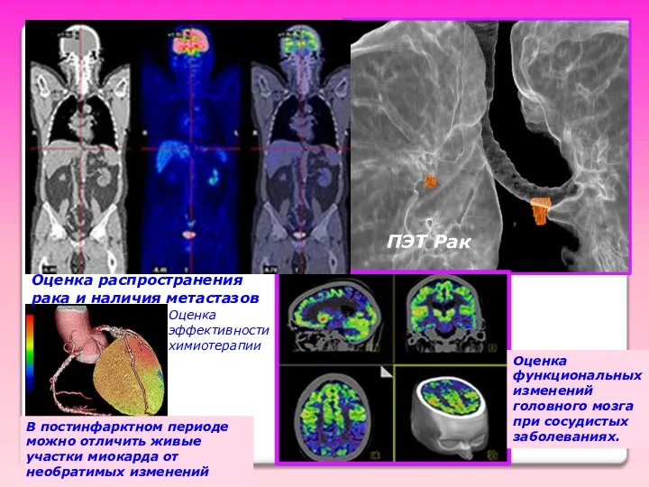 ПЭТ Рак Оценка распространения рака и наличия метастазов В постинфарктном периоде