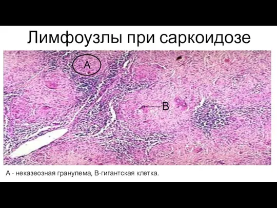 Лимфоузлы при саркоидозе А - неказеозная гранулема, В-гигантская клетка. А В