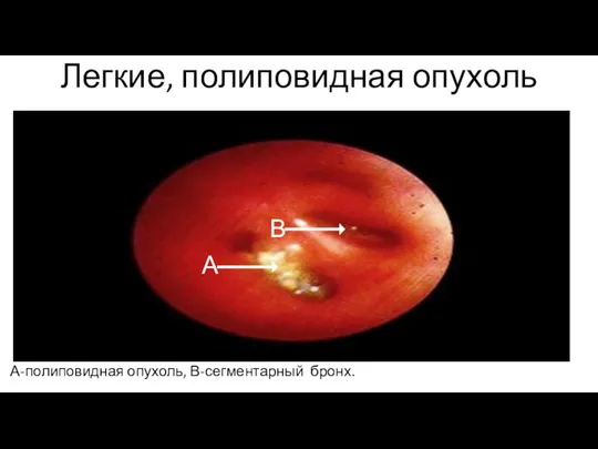 Легкие, полиповидная опухоль А-полиповидная опухоль, В-сегментарный бронх. А В