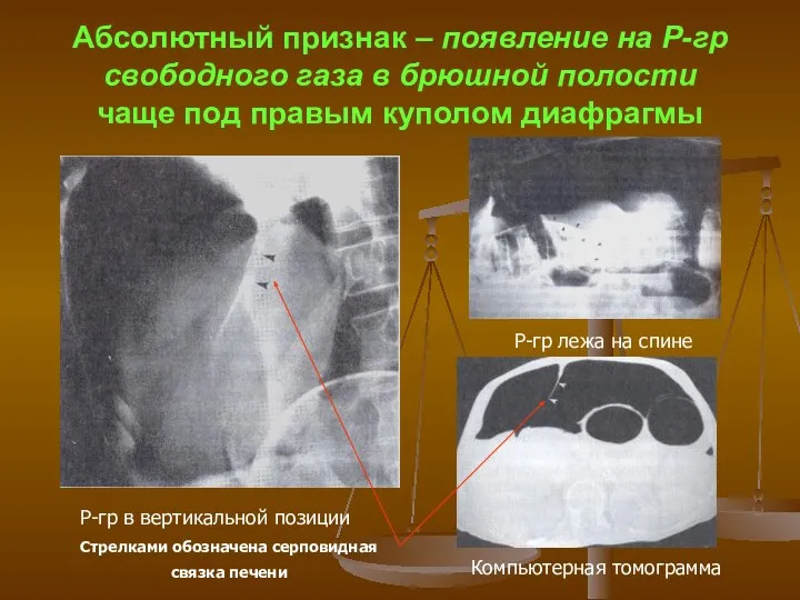 Абсолютный признак – появление на Р-гр свободного газа в брюшной полости